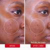 image:imageFirst Aid Beauty Acne Pads for Face  Maximum Strength Acne Treatment  2 Salicylic Acid Pads Treat Without Drying 60ct