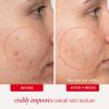 image:imageFirst Aid Beauty Acne Pads for Face  Maximum Strength Acne Treatment  2 Salicylic Acid Pads Treat Without Drying 60ct